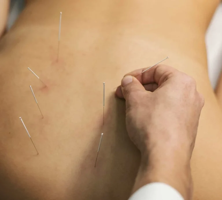 טיפול בדיקור מערבי ראשון לציון והסביבה