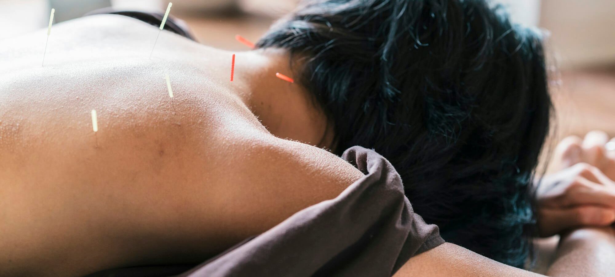 Therapist Giving Cupping Treatment To Young Asian Woman דיקור מערבי יבש